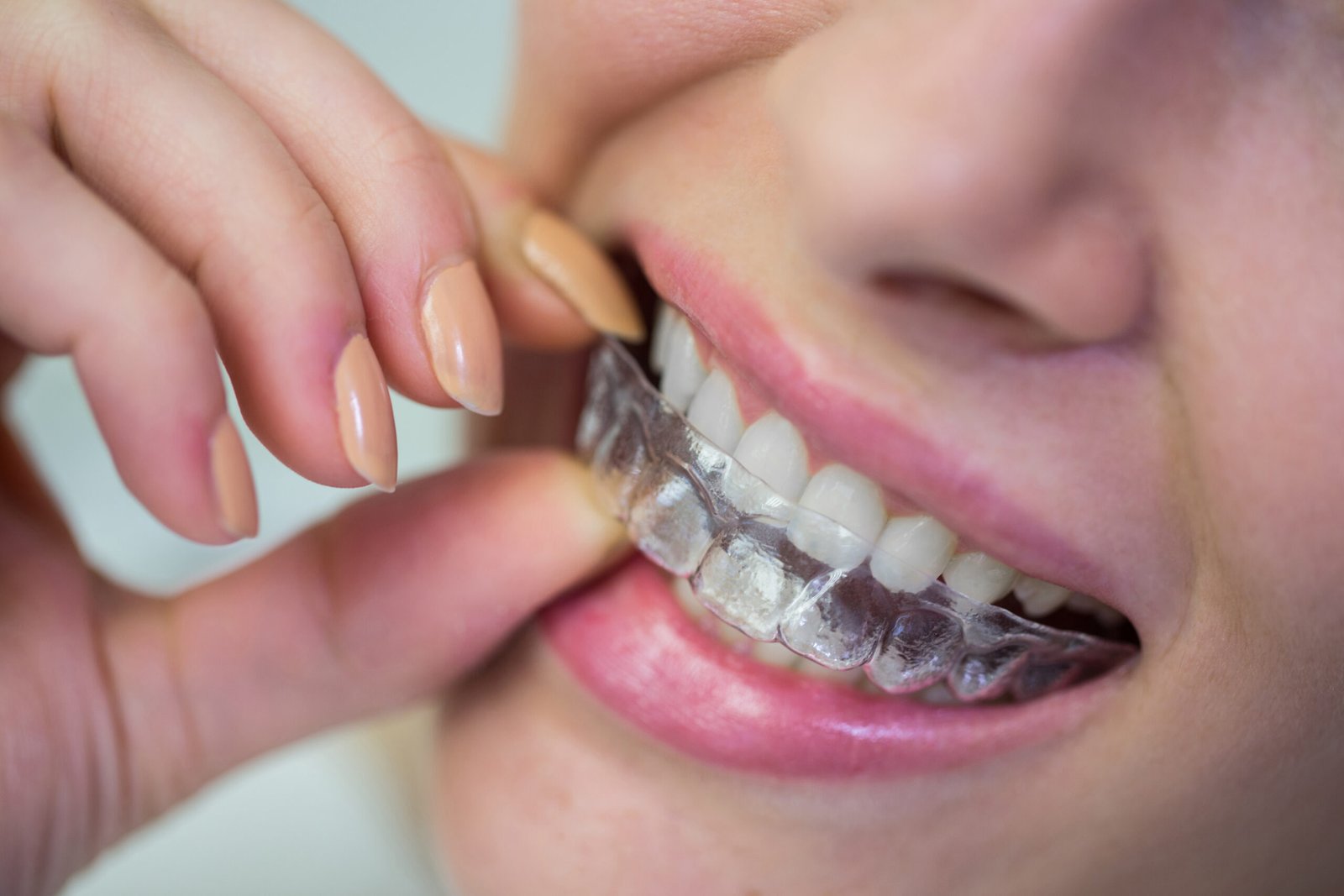 Best Invisalign Treatment in Kondapur | Advanced Clear Aligners